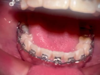 CUM IN MY BRACES