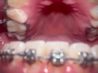 CUM IN MY BRACES