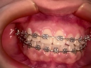 CUM IN MY BRACES